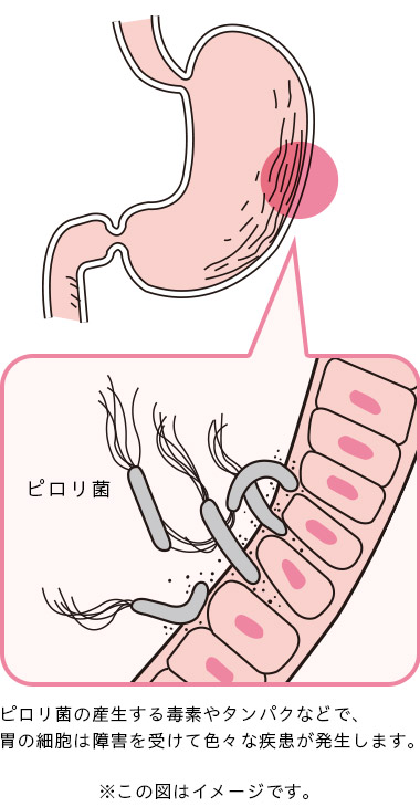 ピロリ 菌 症状